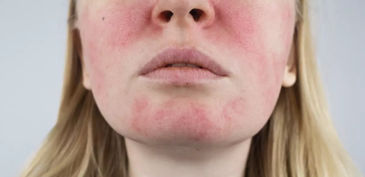 Woman with rosacea on face.